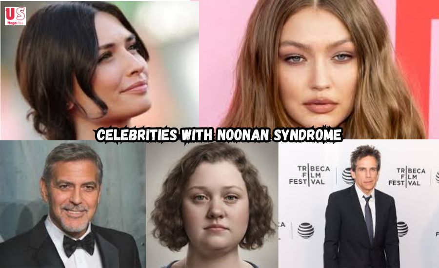 celebrities with noonan syndrome